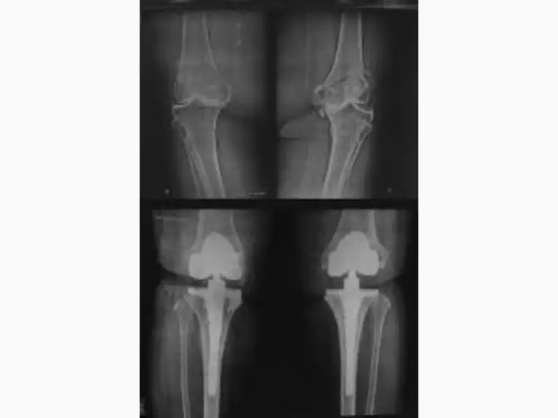 Joint Replacement Hospital in Indore