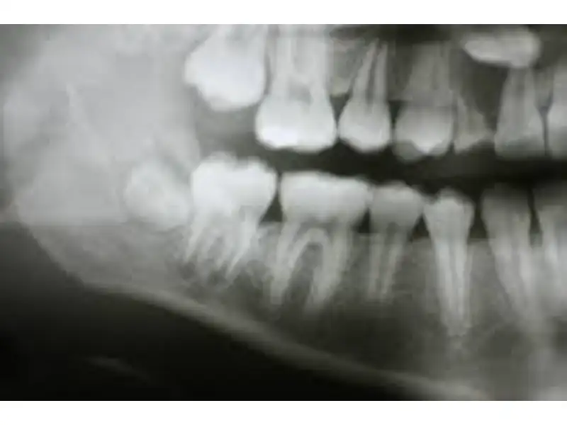 OPG  in Indore(Orthopantomogram)